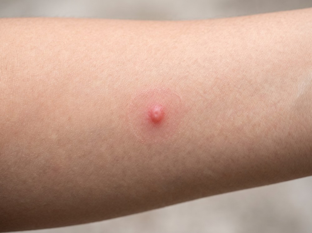 Close-up photo of a fresh black horse fly bite on skin showing a raised red welt with a small amount of surface bleeding